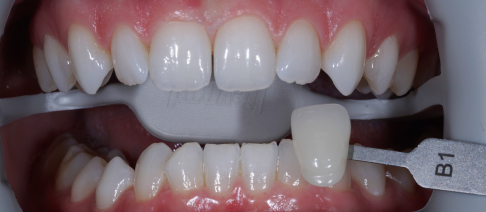 bielenie zubov Trnava